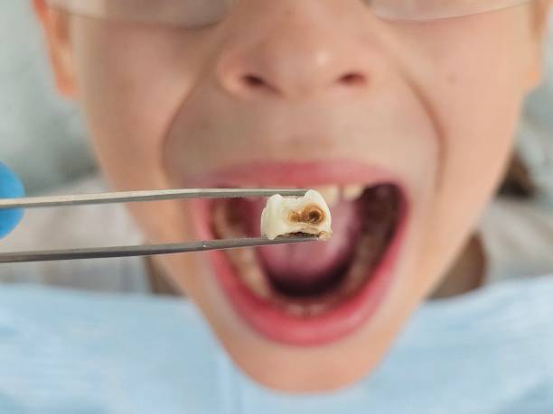 Best Emergency Tooth Extraction in Casa Blanca, AZ